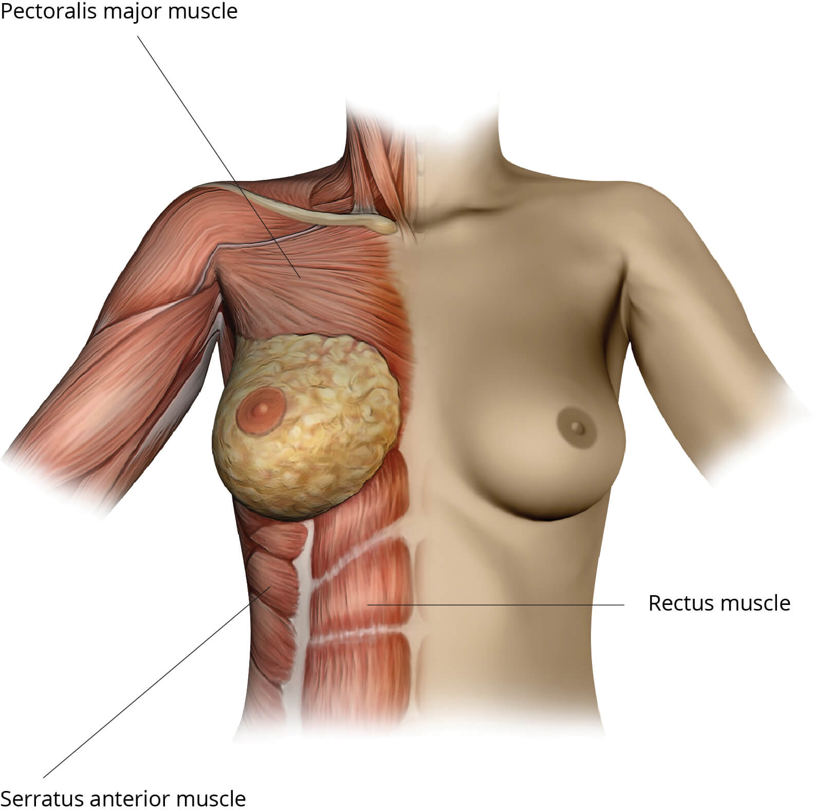 Often Unaware Solution For Uneven Breasts: Lumpectomy prosthesis - Amoena