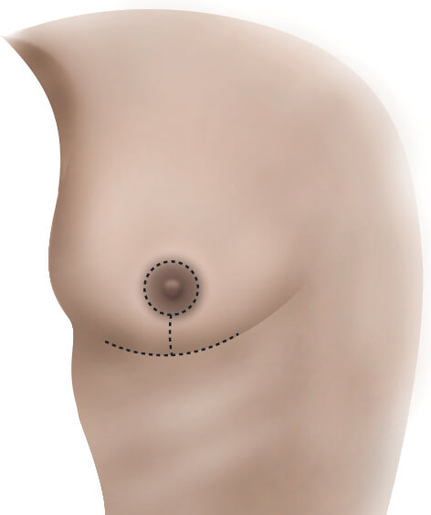 Braza - Foam Mastectomy Breast Form Prosthesis Bra Insert Pads - 5