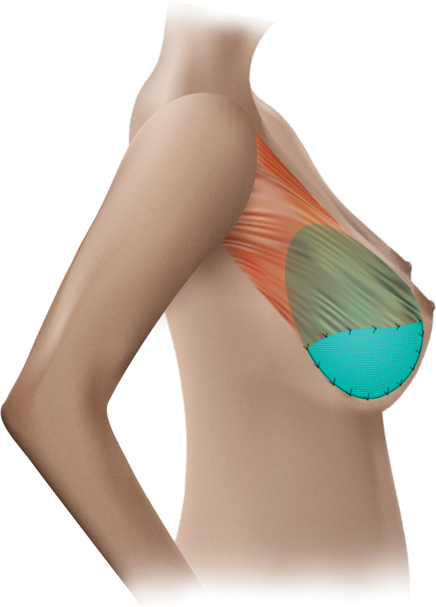 Breast Tissue Migration: Fact or Fiction? - Lingerie Briefs ~ by
